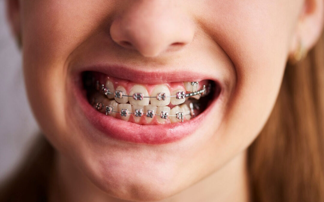 Efectos secundarios de los Brackets