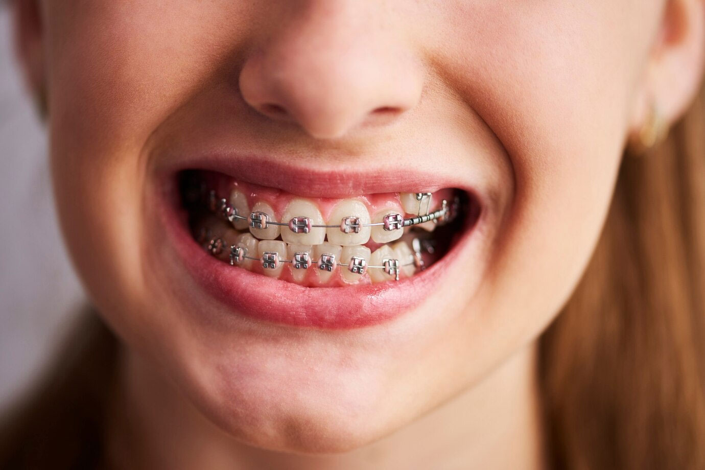 Efectos secundarios de los Brackets