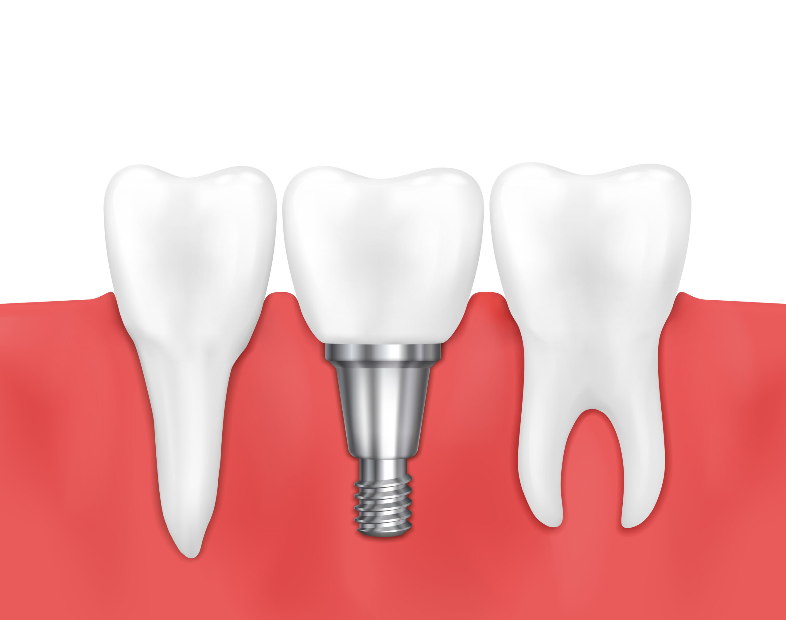 Consejos para el mantenimiento de implantes dentales
